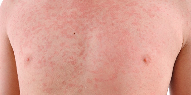 Maya symptoms start with fever, cough, flowing nose and red eyes, then it rashes.