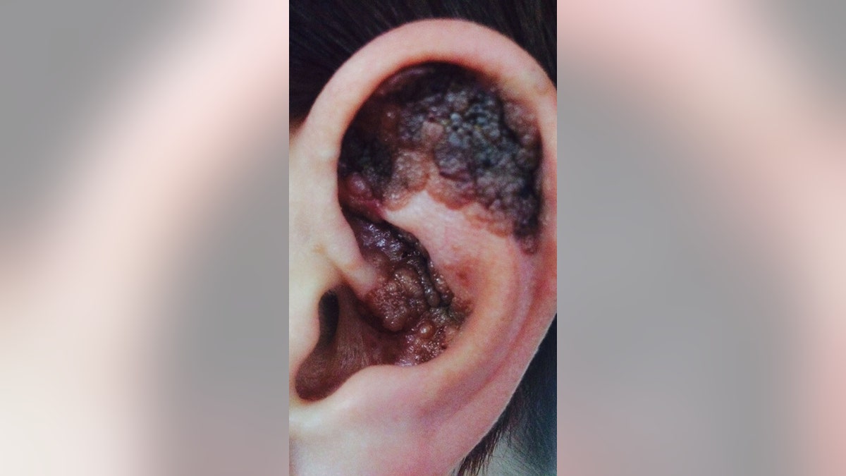 She claims doctors repeatedly dismissed an "itchy" lump she had discovered in her ear, until it began scabbing and changing color. 