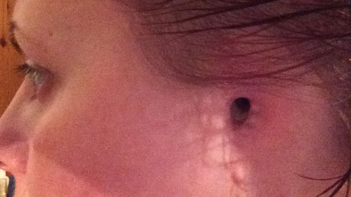 She lost her hearing in her left ear, and now wants tanning beds banned for everyone in the U.K.