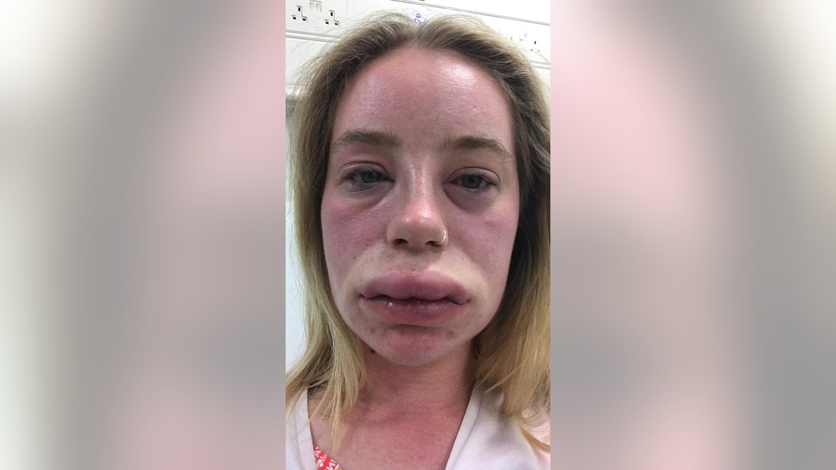 Lydia O'Connor, 23, from Chelmsford, Essex, was diagnosed with chronic idiopathic urticaria and is terrified that the symptoms will return without any warning, at any moment.