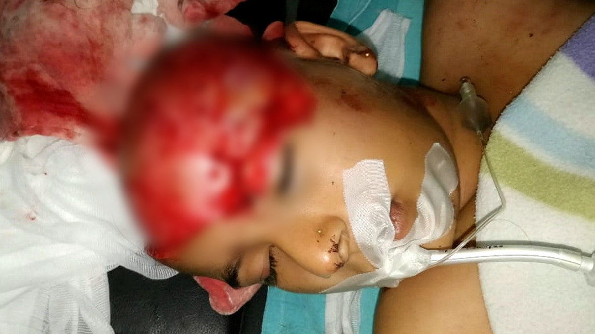 Doctors remarkably reattached a girl's forehead after she was SCALPED when her ponytail got tangled in tractor machinery. 