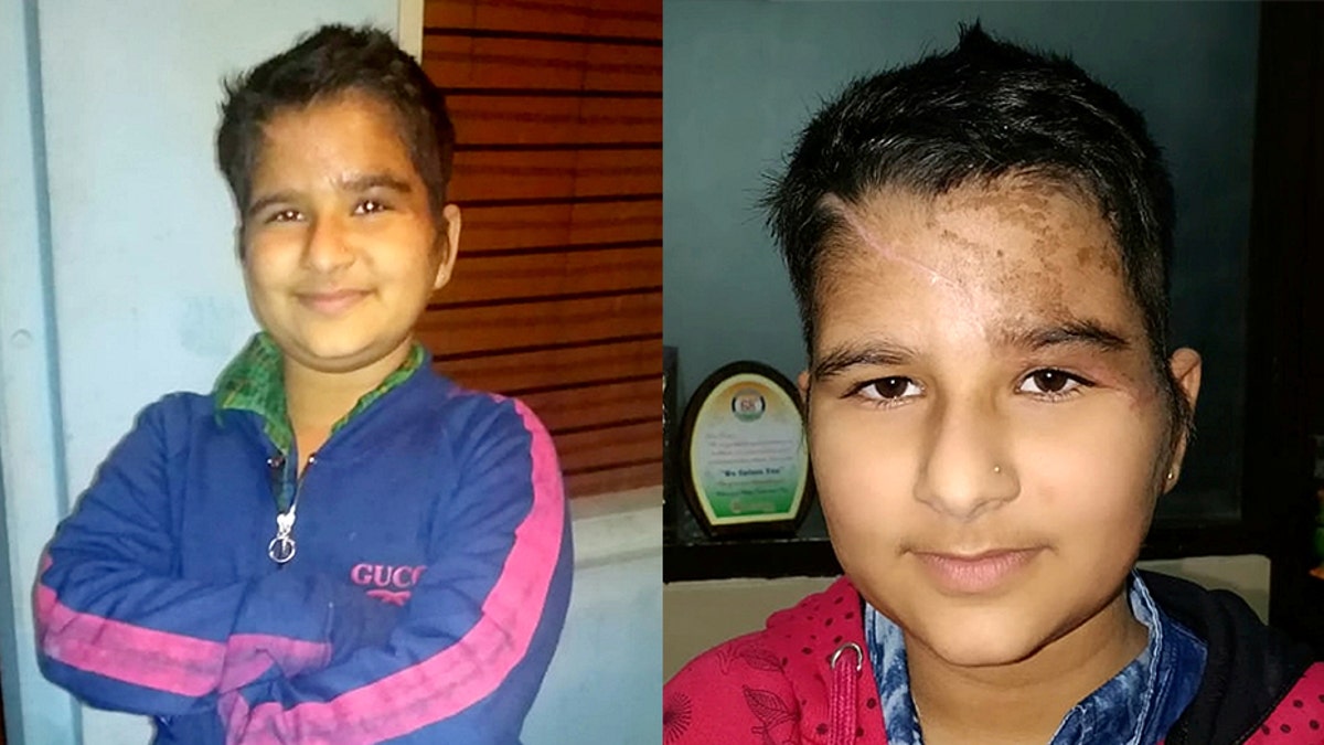 Kushpreet Kaur, aged nine, had her entire scalp and forehead sheared off when her hair got caught in a tractor’s crop spraying mechanism in rural India in November last year.