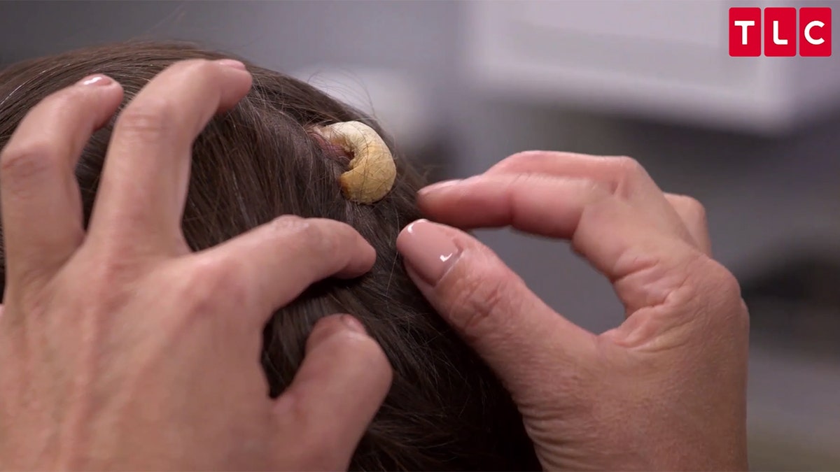 Woman seeks Dr. Pimple Popper s help removing horn on head