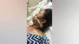 LA teen left with painful blisters, burns in severe reaction to medication