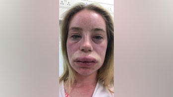 Woman left suffering from swollen lips, full-body rash for weeks due to mysterious disorder