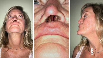 Woman left with 1 nostril hole after botched surgery to fix dog bite