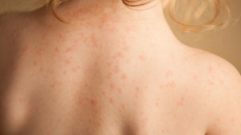 San Diego officials warn of spike in 'wind-borne' children's disease