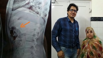 Doctors pull pin from girl's stomach after she accidentally swallowed it while talking