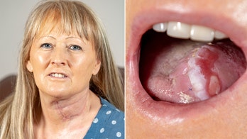 Mom gets new tongue made from arm after cancer diagnosis