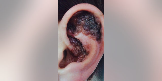 She claims doctors repeatedly dismissed an "itchy" lump she had discovered in her ear, until it began scabbing and changing color.