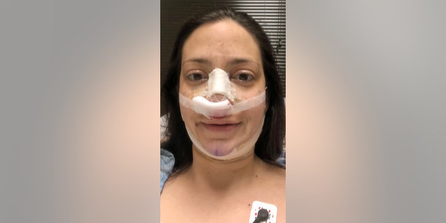 Post surgery recovery from the rhinoplasty and fat transfer to the butt and liposuction.