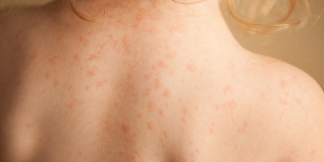 The disease primarily affects children younger than 5 and was first detected in Japan in the 1960s, and then reported in Hawaii in the 1970s.