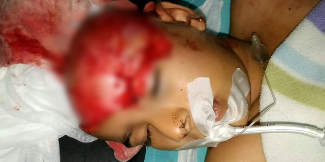 Doctors remarkably reattached a girl's forehead after she was SCALPED when her ponytail got tangled in tractor machinery.