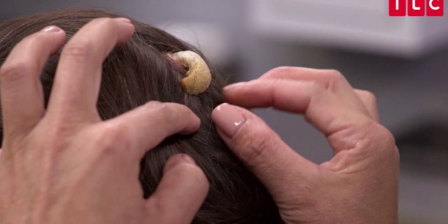 The growth, described by Lisa as a "horn," had been developing for over a year.