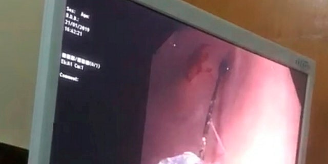 The pin was extracted nearly 10 hours after the girl had swallowed it.