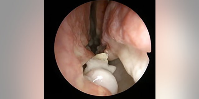 Doctors estimate the extremely rare case occurs in 0.1 to 1 percent of patients worldwide.