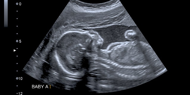 Simpson underwent the procedure at 24 weeks.