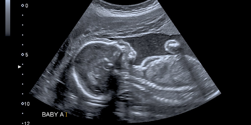 Abortion doctor's family finds remains of more than 2,200 fetuses at his home after his death: reports