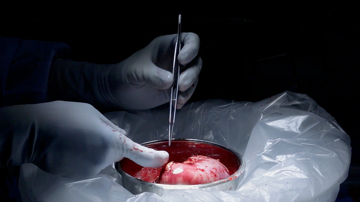 This image made from video provided by Johns Hopkins Medicine in Baltimore shows a kidney from Nina Martinez of Atlanta, who is thought to be the world’s first kidney transplant living donor with HIV, on Monday, March 25, 2019. Doctors transplanted one of her kidneys into an HIV-positive recipient who chose to remain anonymous. (Johns Hopkins Medicine via AP)