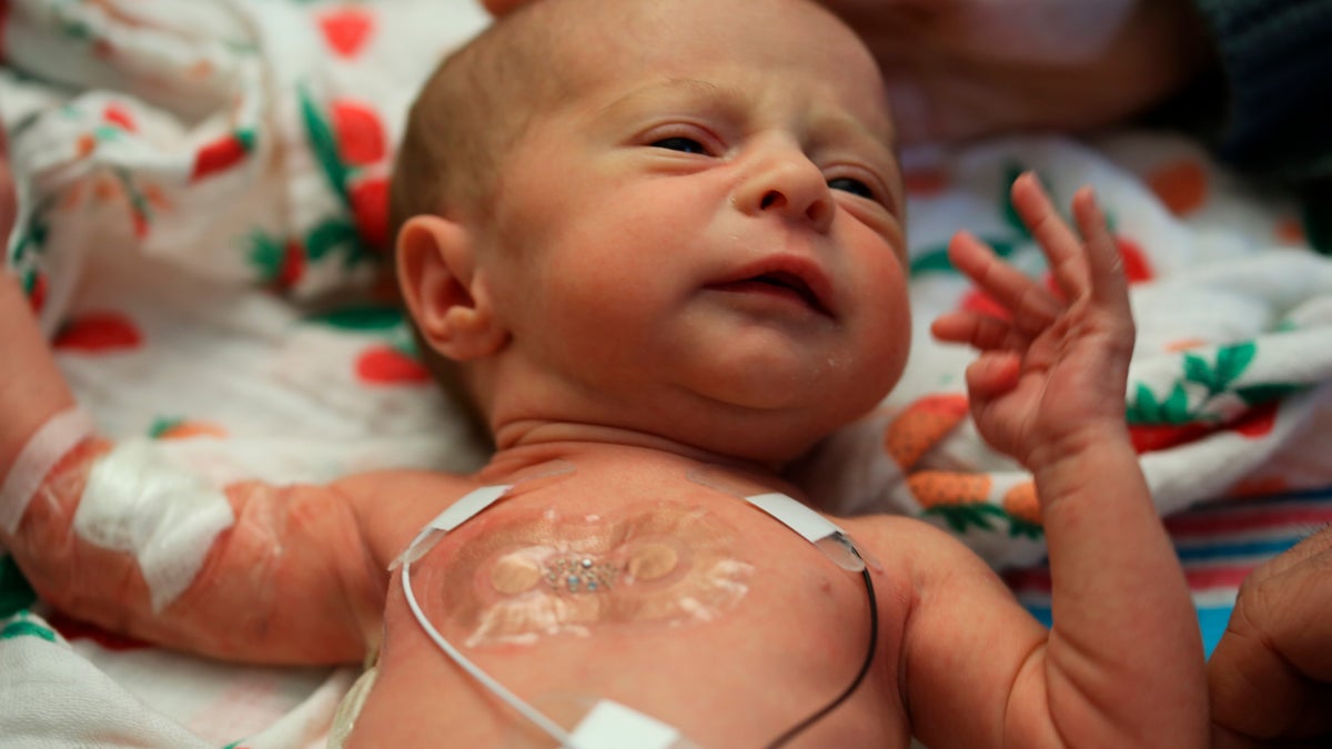 This 2019 photo provided by Northwestern University shows a soft, flexible wireless sensor applied on the chest of a family’s baby, who is involved in the clinical trial at Ann & Robert H. Lurie Children's Hospital of Chicago.