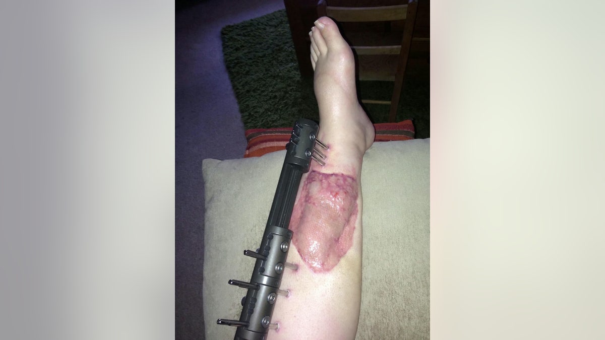She said surgeons cut away dead skin, which left a gaping hole in her leg later filled with muscle taken from another area of her limb.
