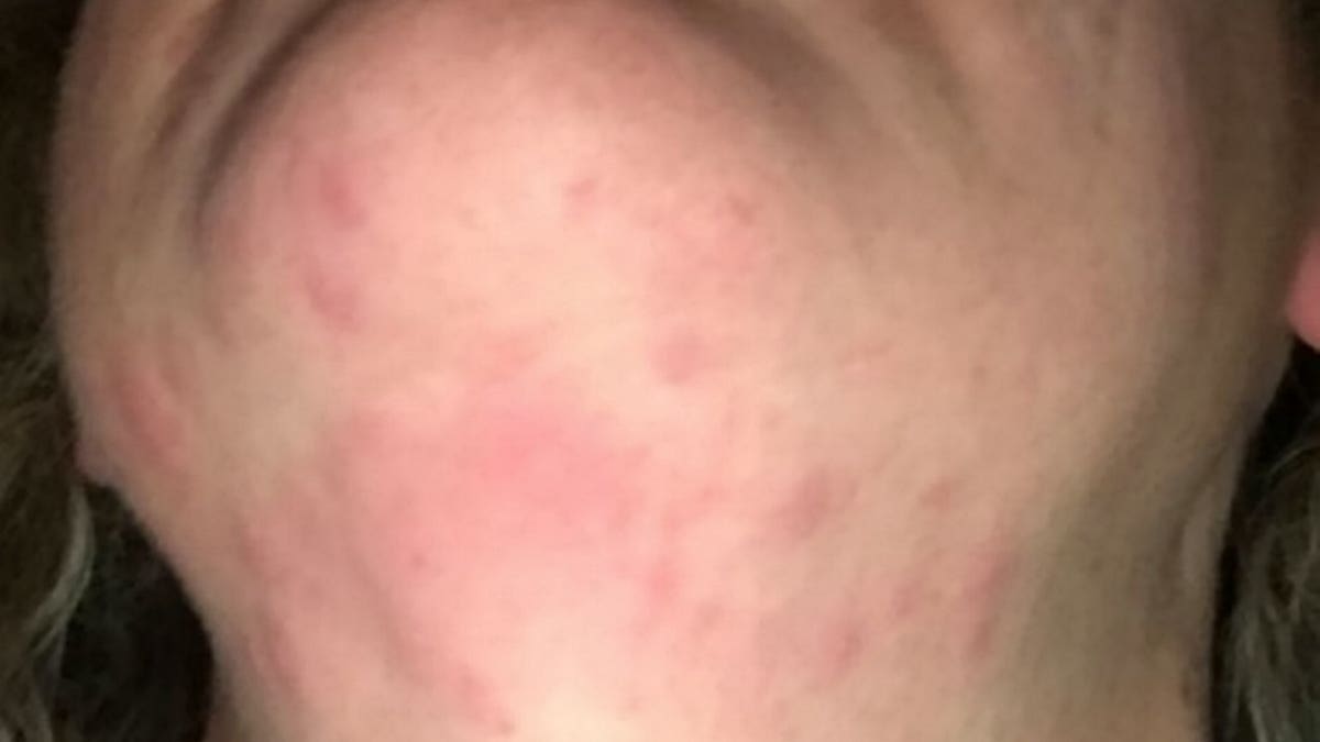 Woman claims allergic reaction to vape caused painful rash