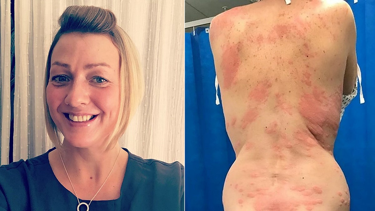 Woman claims allergic reaction to vape caused painful rash