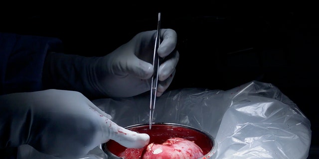 This image made from video provided by Johns Hopkins Medicine in Baltimore shows a kidney from Nina Martinez of Atlanta, who is thought to be the world’s first kidney transplant living donor with HIV, on March 25, 2019. (Johns Hopkins Medicine via AP)