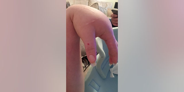 Amy Pohl's infected hand after a failed IV insertion.