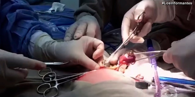 Itzamara's partially developed twin was removed laparoscopically from her abdomen a day after her birth.