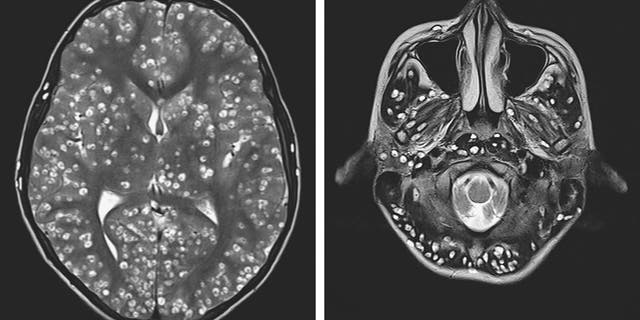 An 18-year-old India man, who was not identified, complained of having pain in his groin and swelling in his eye, was found to have parasites in his brain.<br>