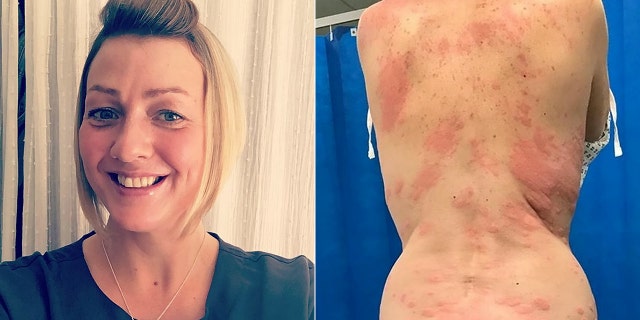 Lisa Santiago-Griggs, 42, said she developed the painful rash after using a vape for the first time.
