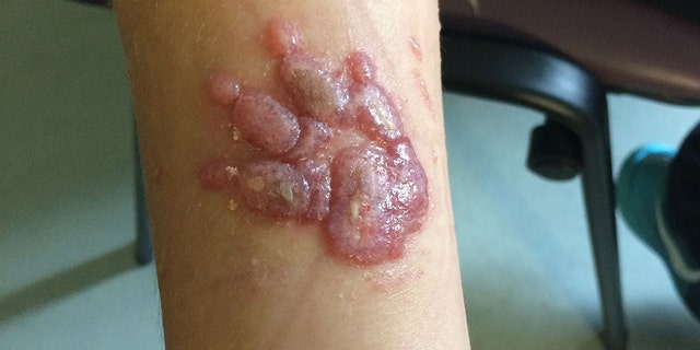 The family said they didn't know about the risks before allowing their son to get the tattoos.