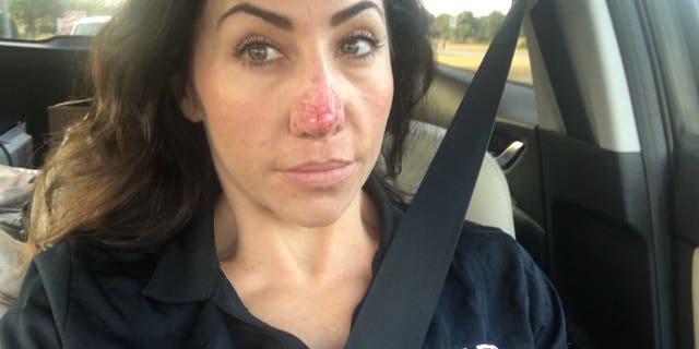 She said her symptoms started with a reddening of the tip of her nose.