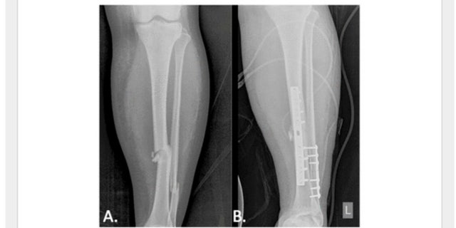 She said that doctors eventually discovered a bacterial infection was preventing her from fully healing.