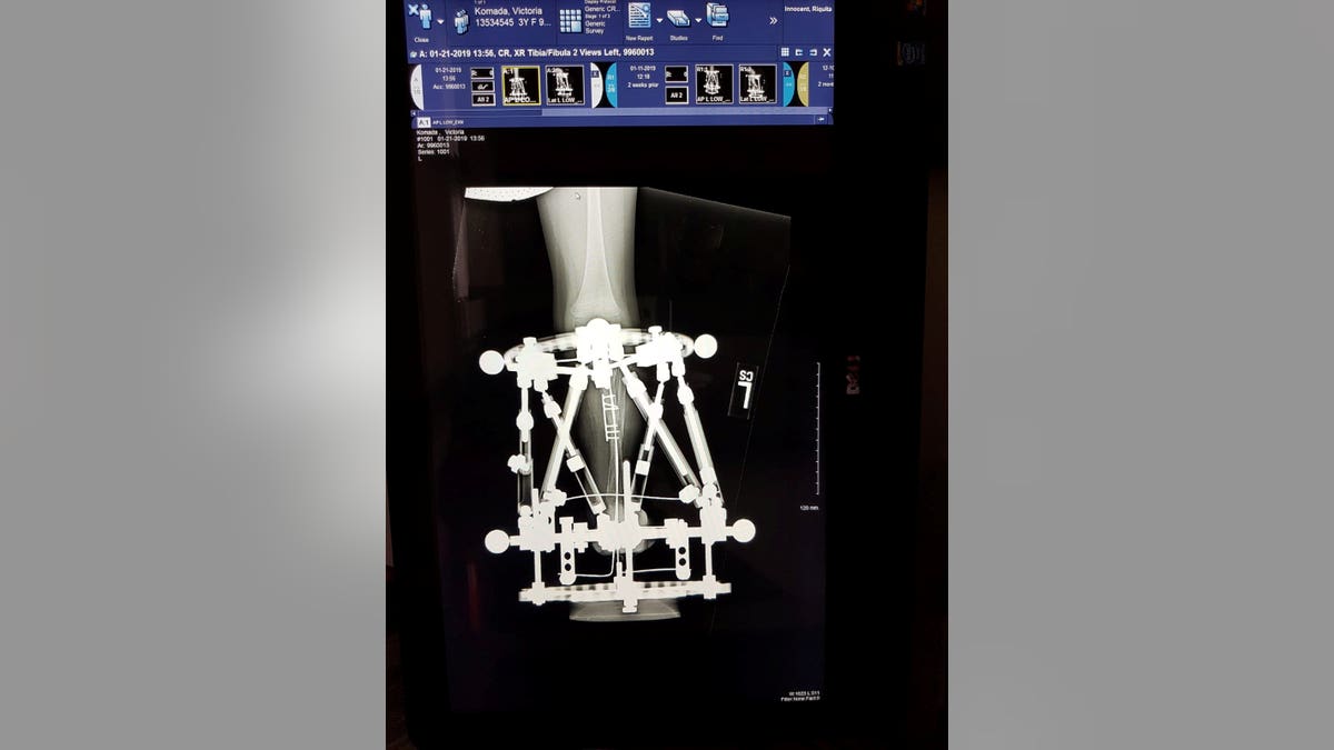 Victoria had her first nine-hour operation on July 24, when her right leg was amputated above her knee and pins were put into her left leg before a fixator was attached.