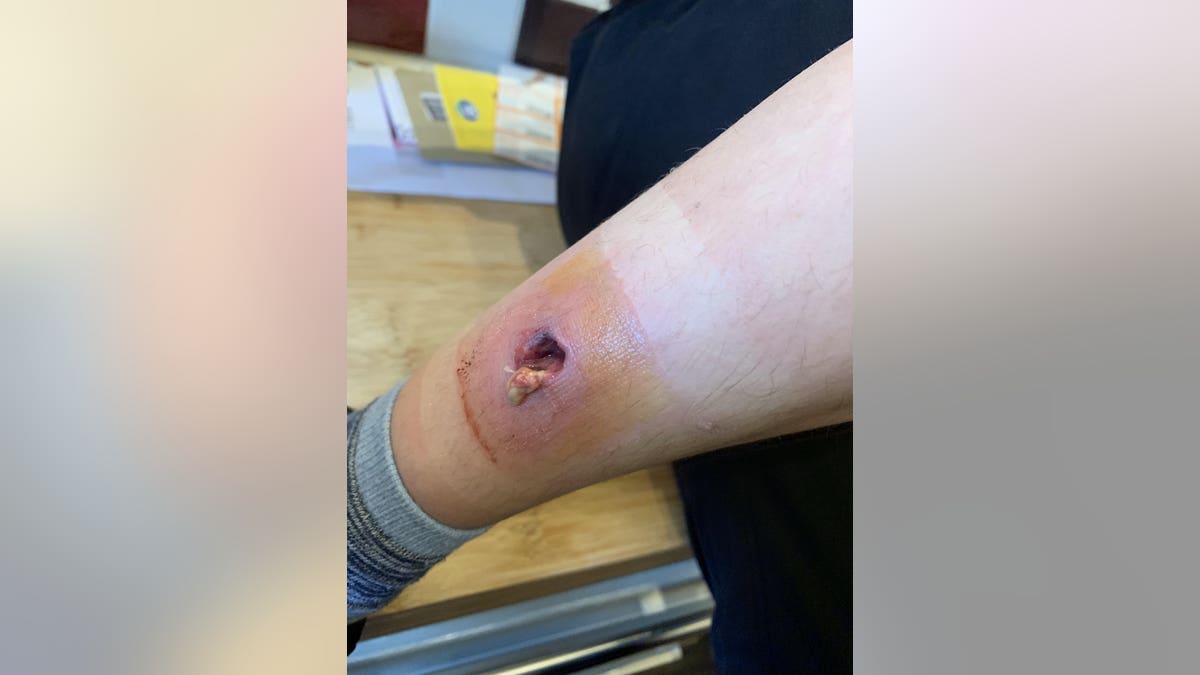Barnett said that she panicked when she saw the hole in her son's leg.