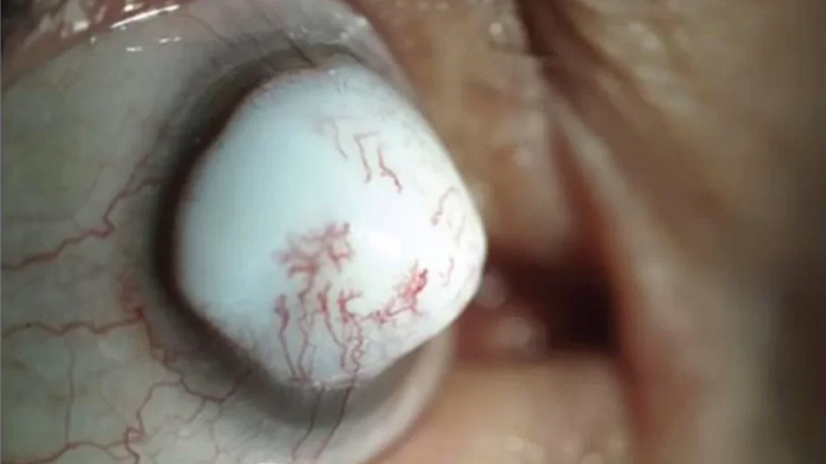 This odd eye problem is the result of a rare lesion on a man's eyeball,