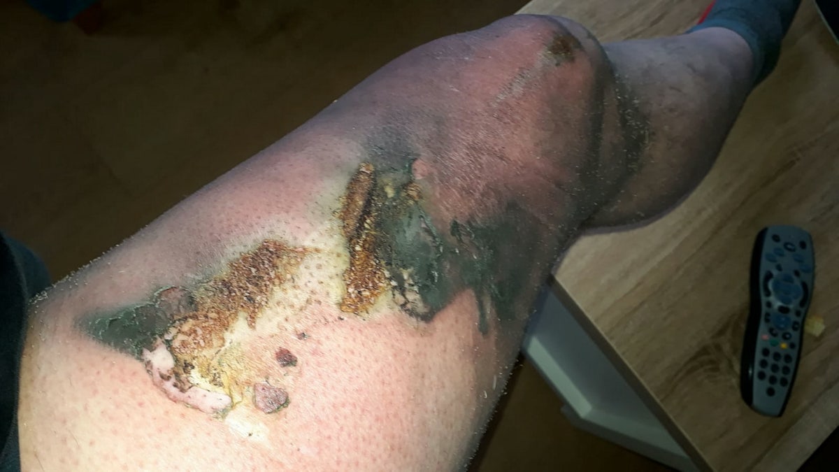 Man claims vape pen left him with third degree burns after pocket