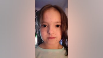 Girl's attempt at 'faking chickenpox' to miss test backfires after she uses permanent marker