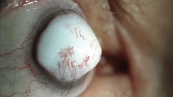 Man develops odd lesion on eyeball 2 years after cataract surgery