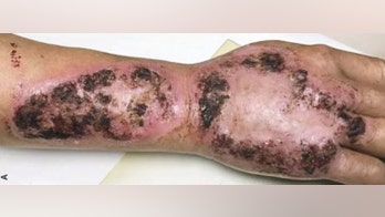 Farmer diagnosed with 'gardener's disease,' which ‘ate away at his arm’