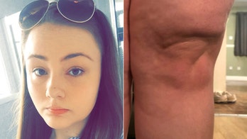 Woman claims life was 'ruined' after her 'legs were crushed' on log flume ride