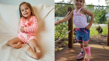 3-year-old born with 'backward' legs takes first steps after pioneering surgery
