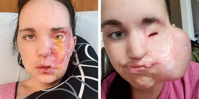 Sullivan has undergone several surgeries, including on her nose, lip and eyelids. She also required new skin for skin grafts, which doctors obtained by using a tissue expander on the side of her face.