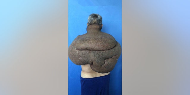 Tang reportedly lived with the tumor for over 30 years but could not find a doctor willing to take on his case.
