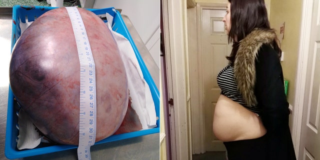When she was sent for an ultrasound, Cummins said doctors estimated that the mass had grown to be around 20 centimeters, but later they discovered it was double that size.