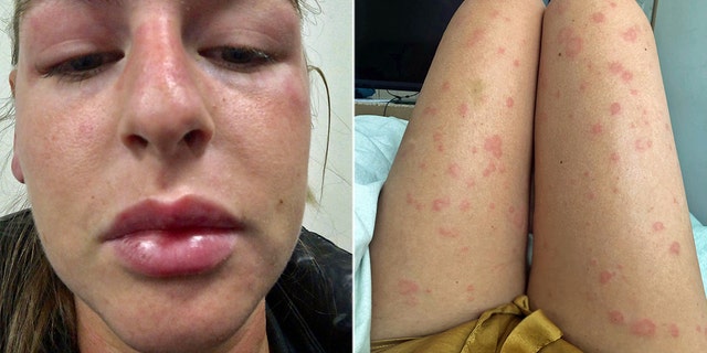 Woman's 'mystery allergy' leaves her covered in hives ...