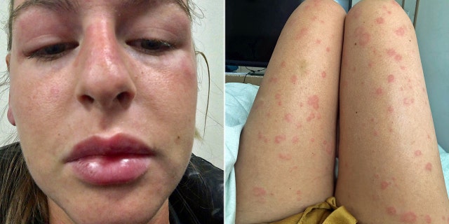 Woman's 'mystery allergy' leaves her covered in hives ...