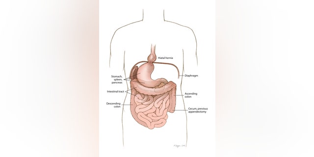 This medical illustration shows how Bentley’s abdominal organs were a mirror image of typical human anatomy, meaning they were transposed right to left. She also had an abnormality called a hiatal hernia, which is when a portion of the stomach protrudes through the diaphragm, a thin muscle that separates the abdomen from the chest.
